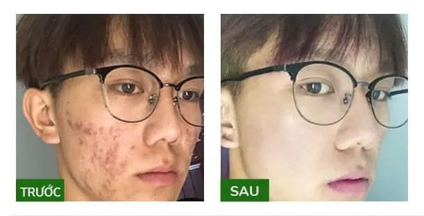 ONETE Detox Deep Cleansing Gel SỮA RỬA MẶT THẢO DƯỢC ĐIỀU TRỊ DA MỤN HIỆU QUẢ 13 trước sau khi dùng kem trị mụn onete myphamhera.com
