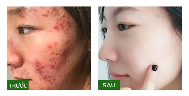 ONETE Detox Deep Cleansing Gel SỮA RỬA MẶT THẢO DƯỢC ĐIỀU TRỊ DA MỤN HIỆU QUẢ 14 trước sau khi dùng kem trị mụn onete myphamhera.com