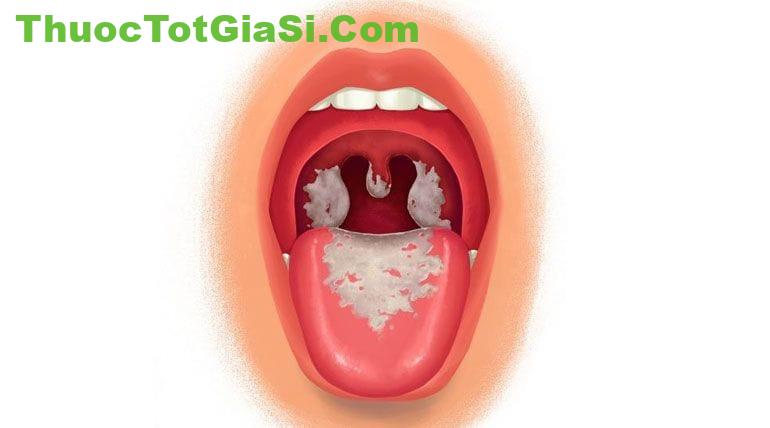 Bệnh bạch hầu là bệnh nhiễm khuẩn cấp tính có giả mạc ở tuyến hạnh nhân, hầu họng, thanh quản, mũi.